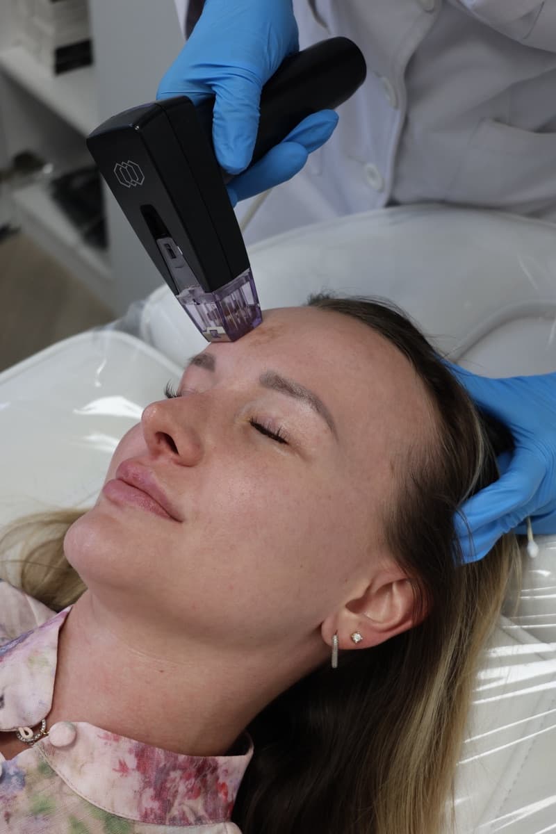 Client receiving Morpheus8 RF microneedling at FusionMed Toronto