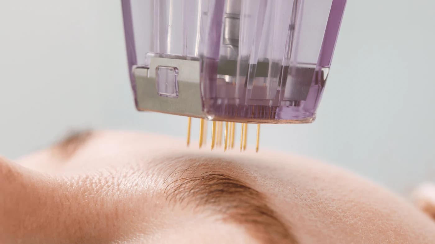 Advanced laser and RF treatment in a medical clinic