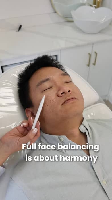 This is what a balanced procedure looks like.
Chin filler · Nasolabial softening